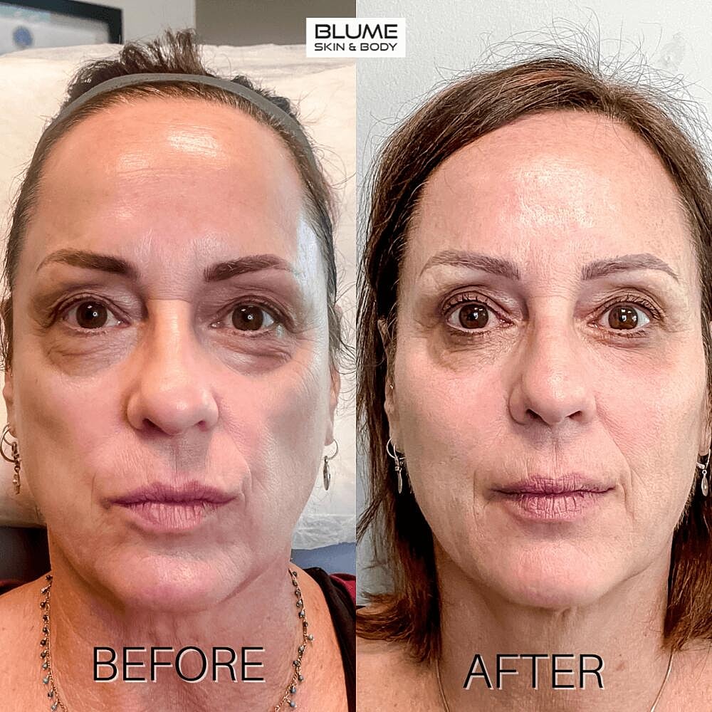 Laser Skin Treatments Before & After