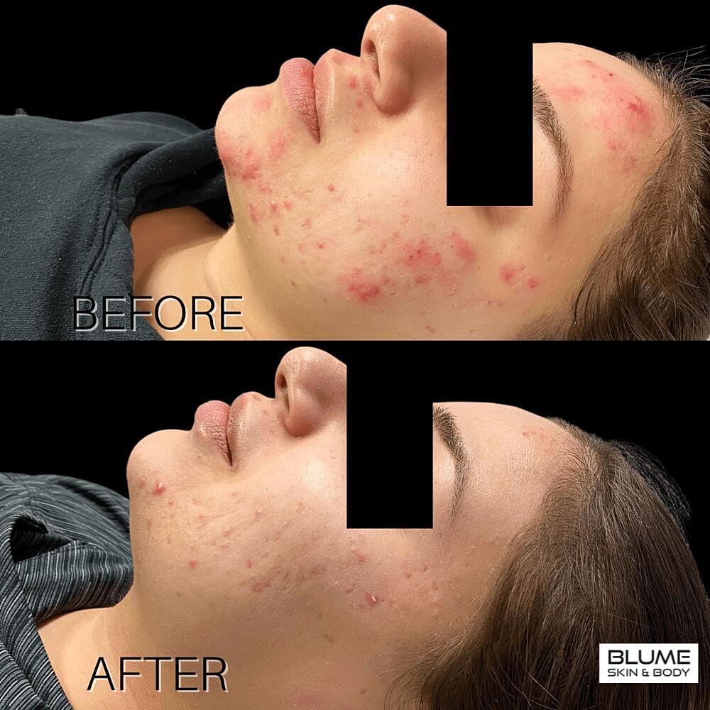 Laser Skin Treatments Before & After
