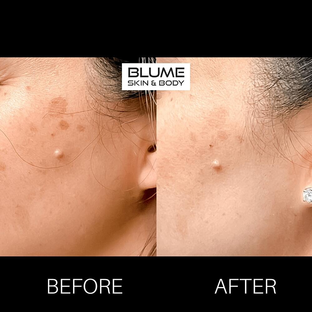Laser Skin Treatments Before & After