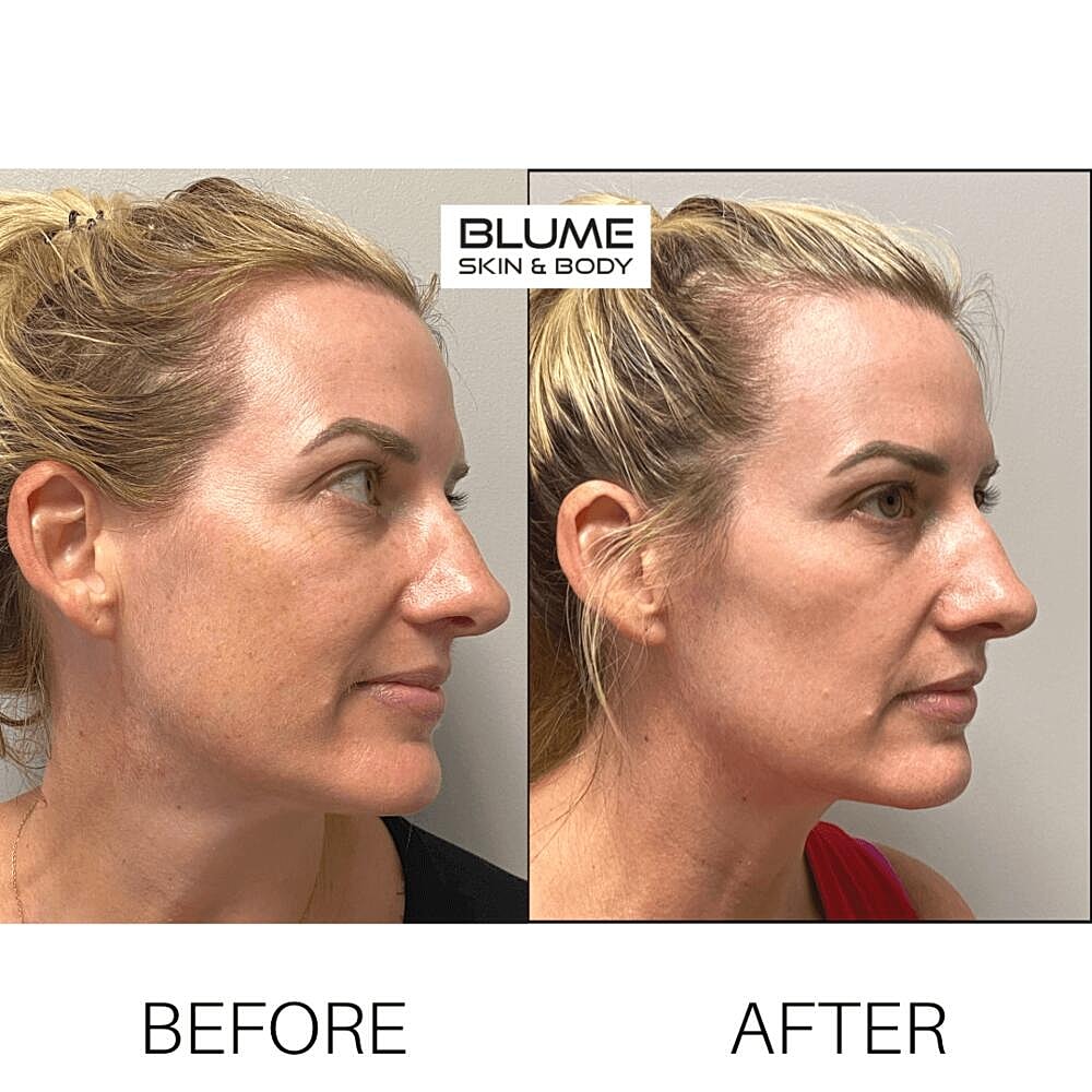 Laser Skin Treatments Before & After