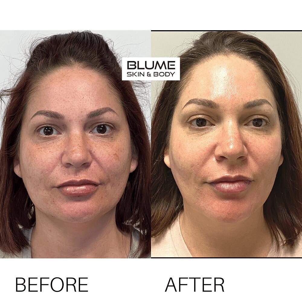 Laser Skin Treatments Before & After