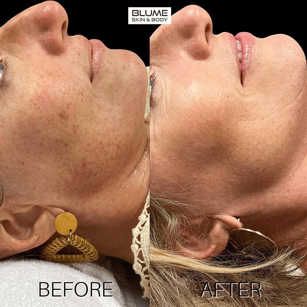 Laser Skin Treatments Before & After