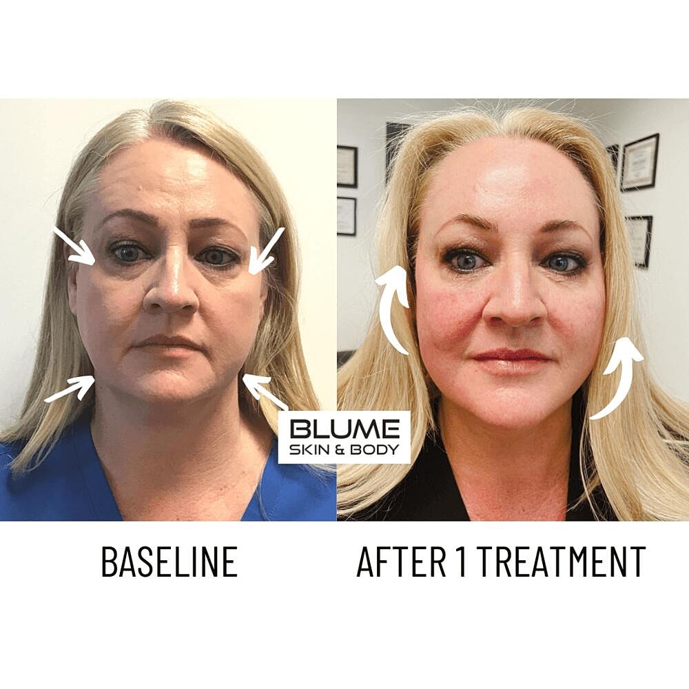 Laser Skin Treatments Before & After