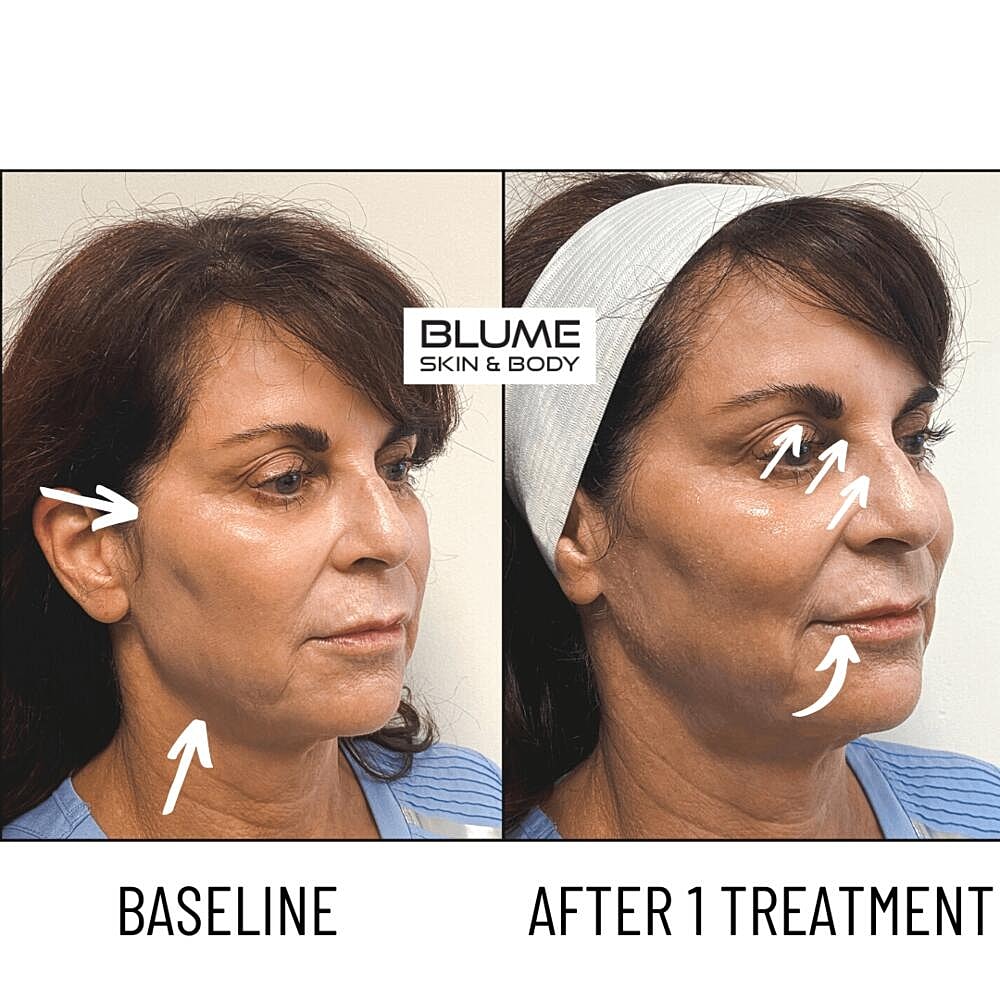 Laser Skin Treatments Before & After