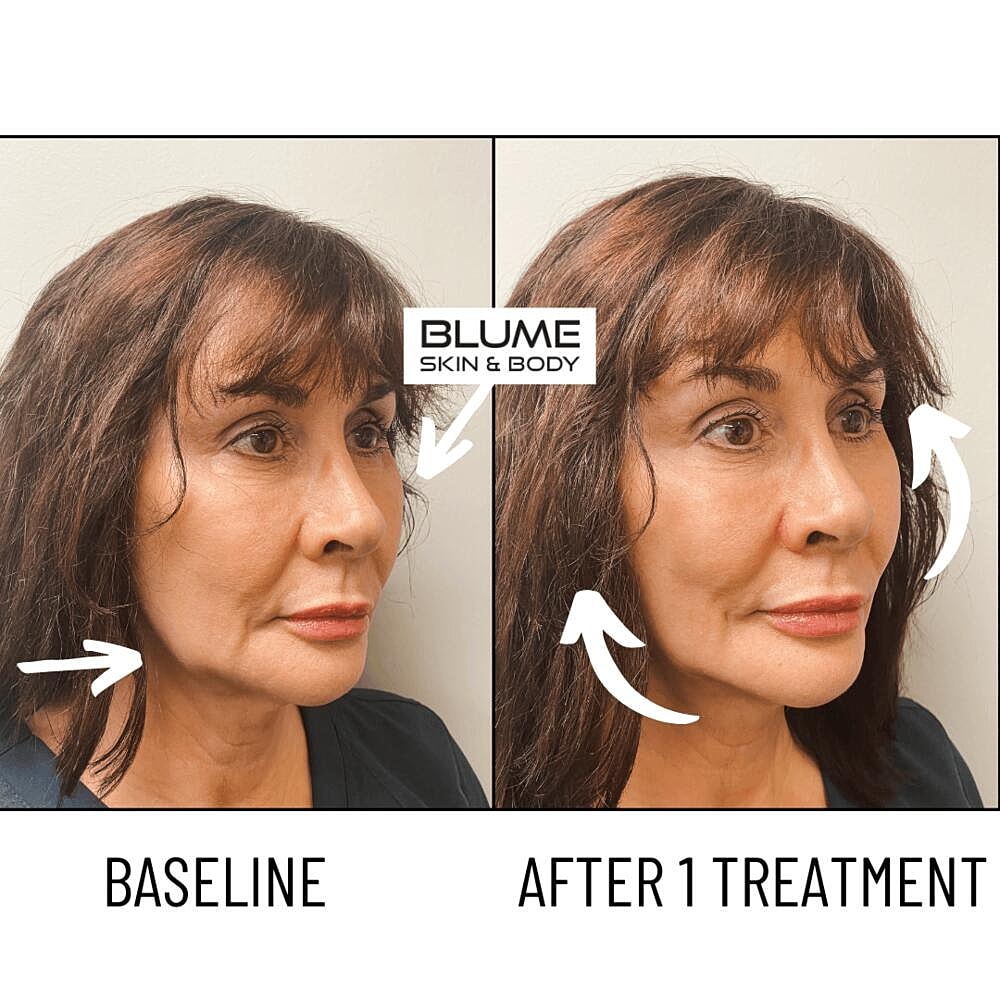 Laser Skin Treatments Before & After