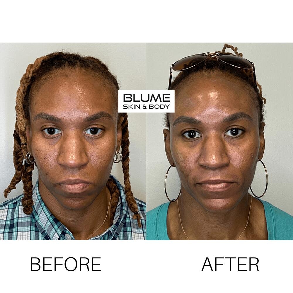 Laser Skin Treatments Before & After