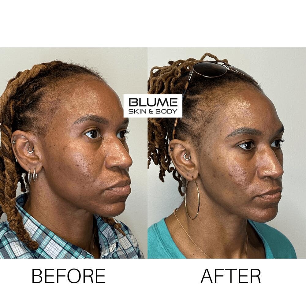 Laser Skin Treatments Before & After