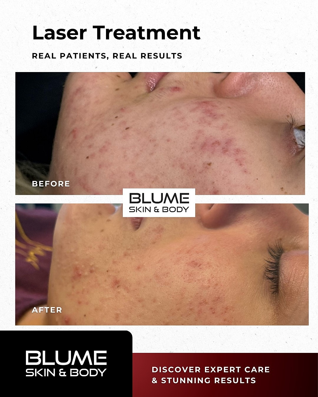 Laser Skin Treatments Before & After
