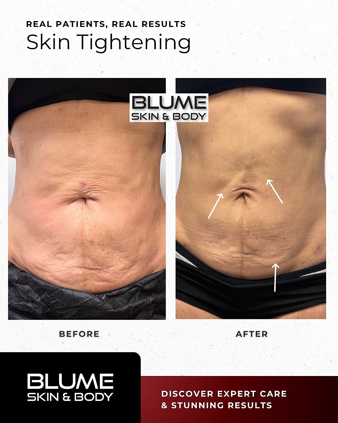 Laser Skin Treatments Before & After