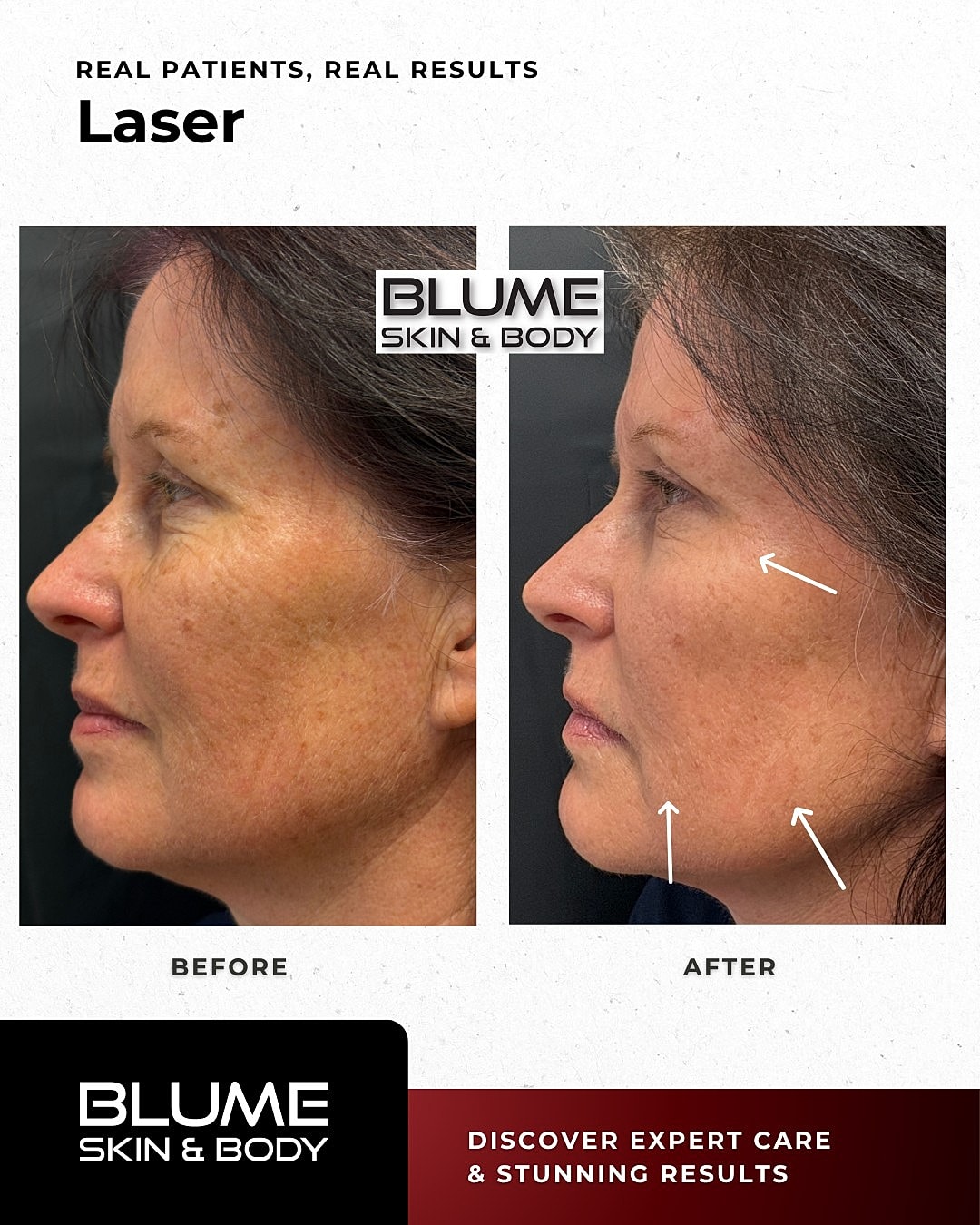 Laser Skin Treatments Before & After