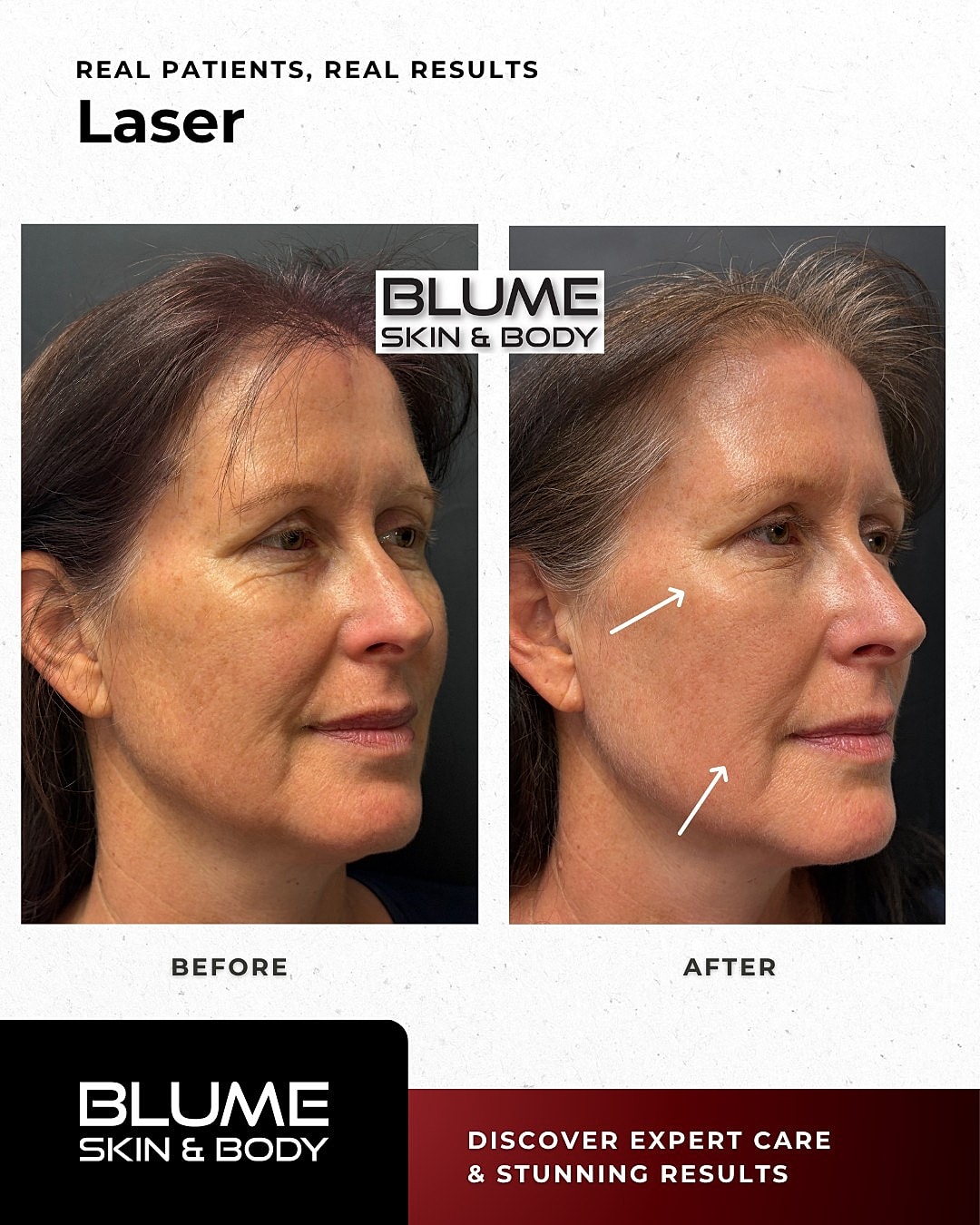 Laser Skin Treatments Before & After