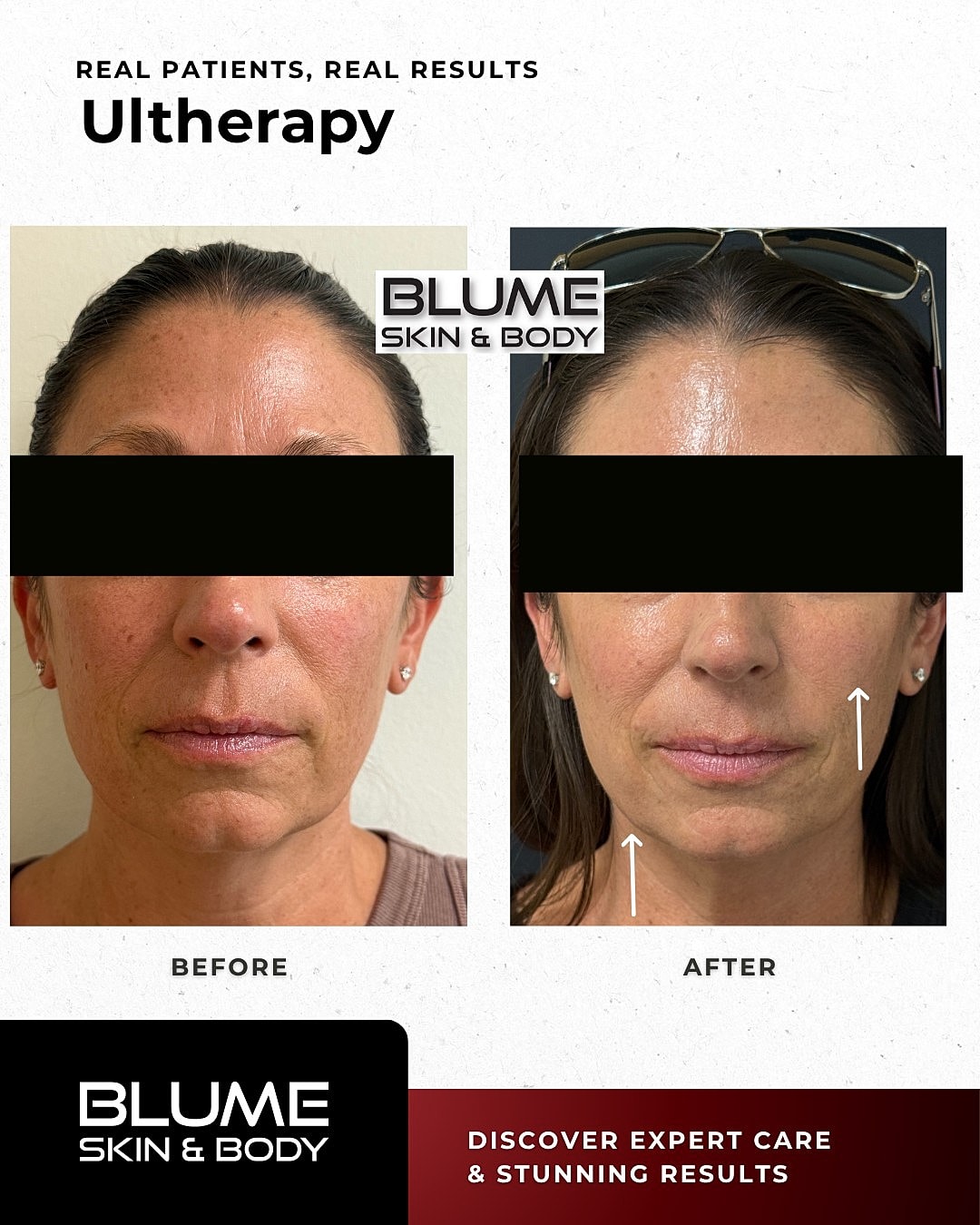 Before and after Ultherapy treatment results
