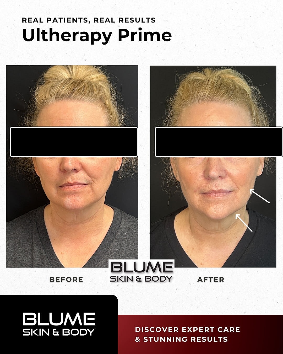 Laser Skin Treatments Before & After