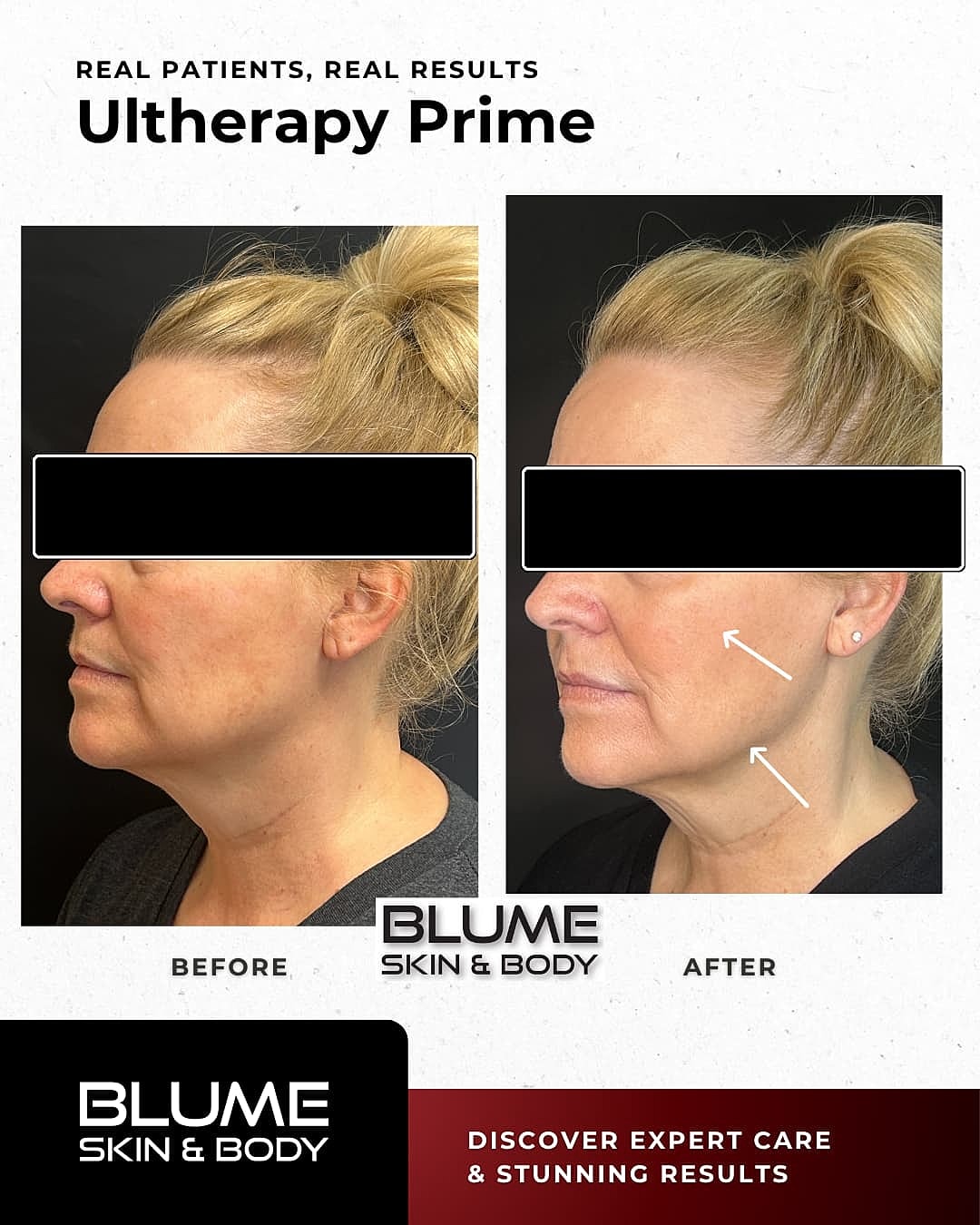 Laser Skin Treatments Before & After