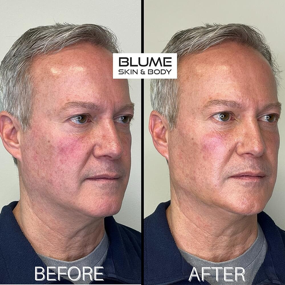 Botox Before & After