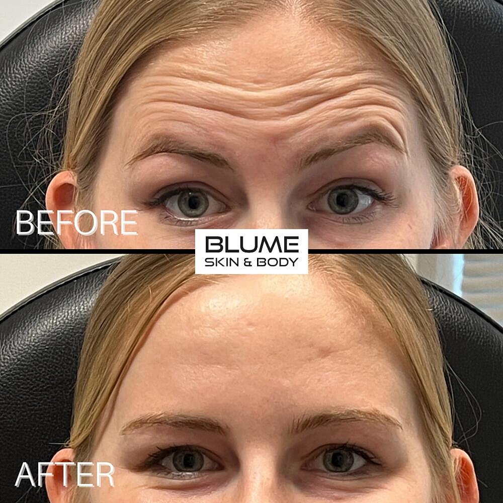 Botox Before & After