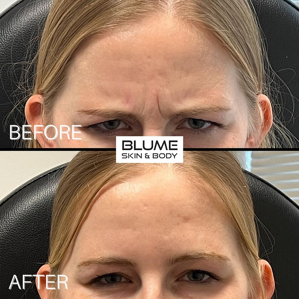 Botox Before & After