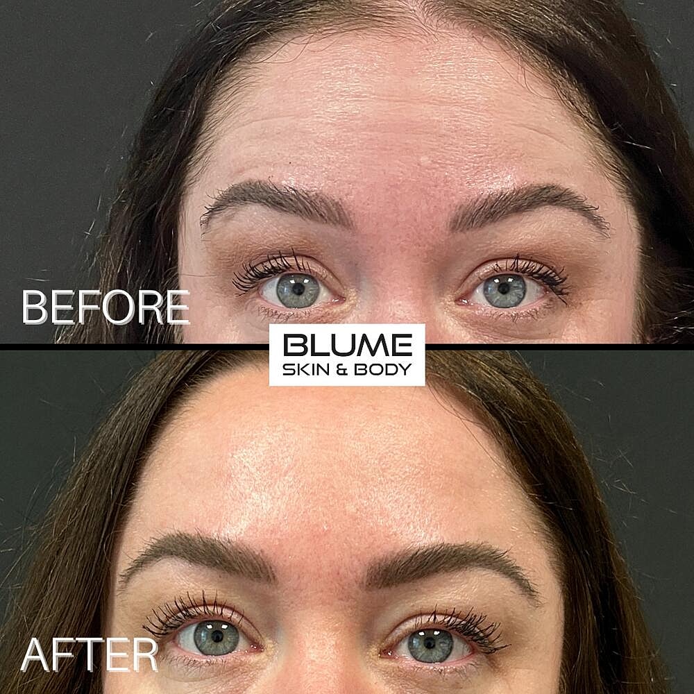 Botox Before & After