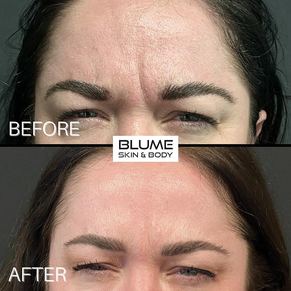 Botox Before & After