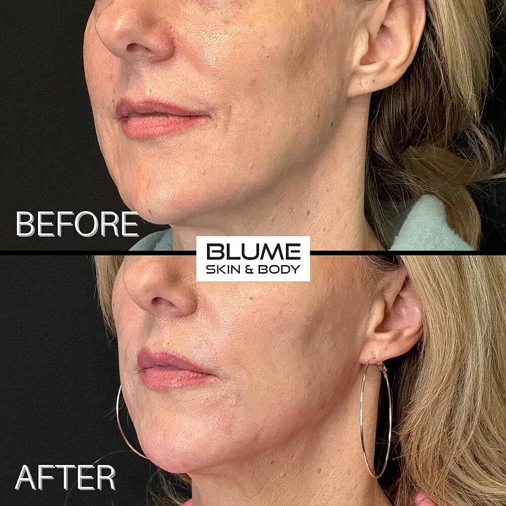 Botox Before & After