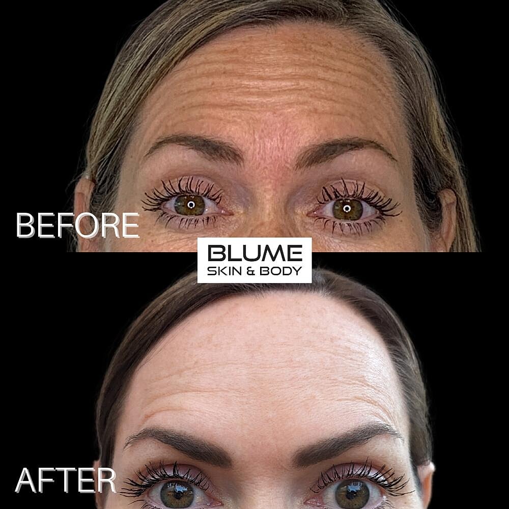 Botox Before & After