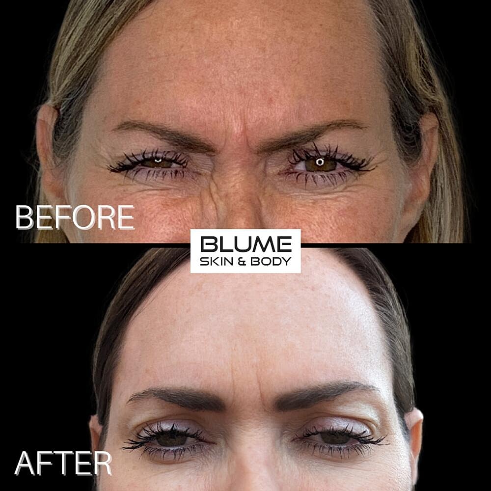 Botox Before & After