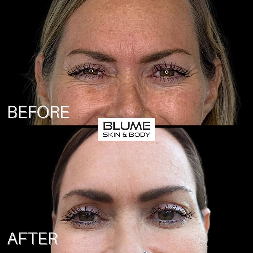 Botox Before & After