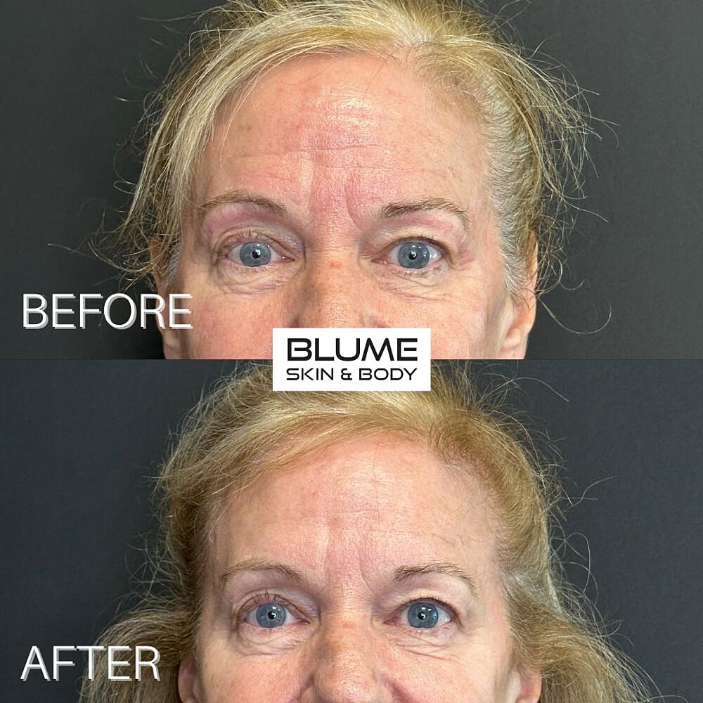 Botox Before & After