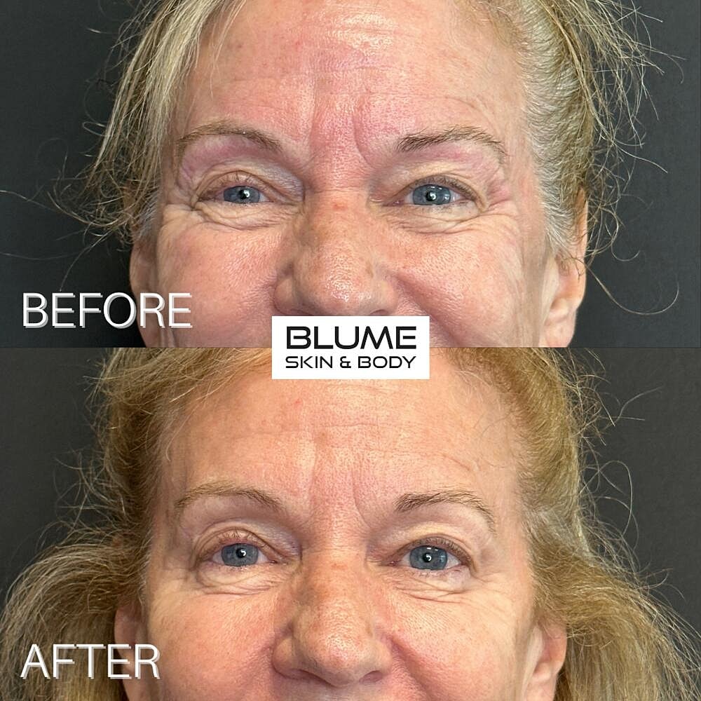 Botox Before & After