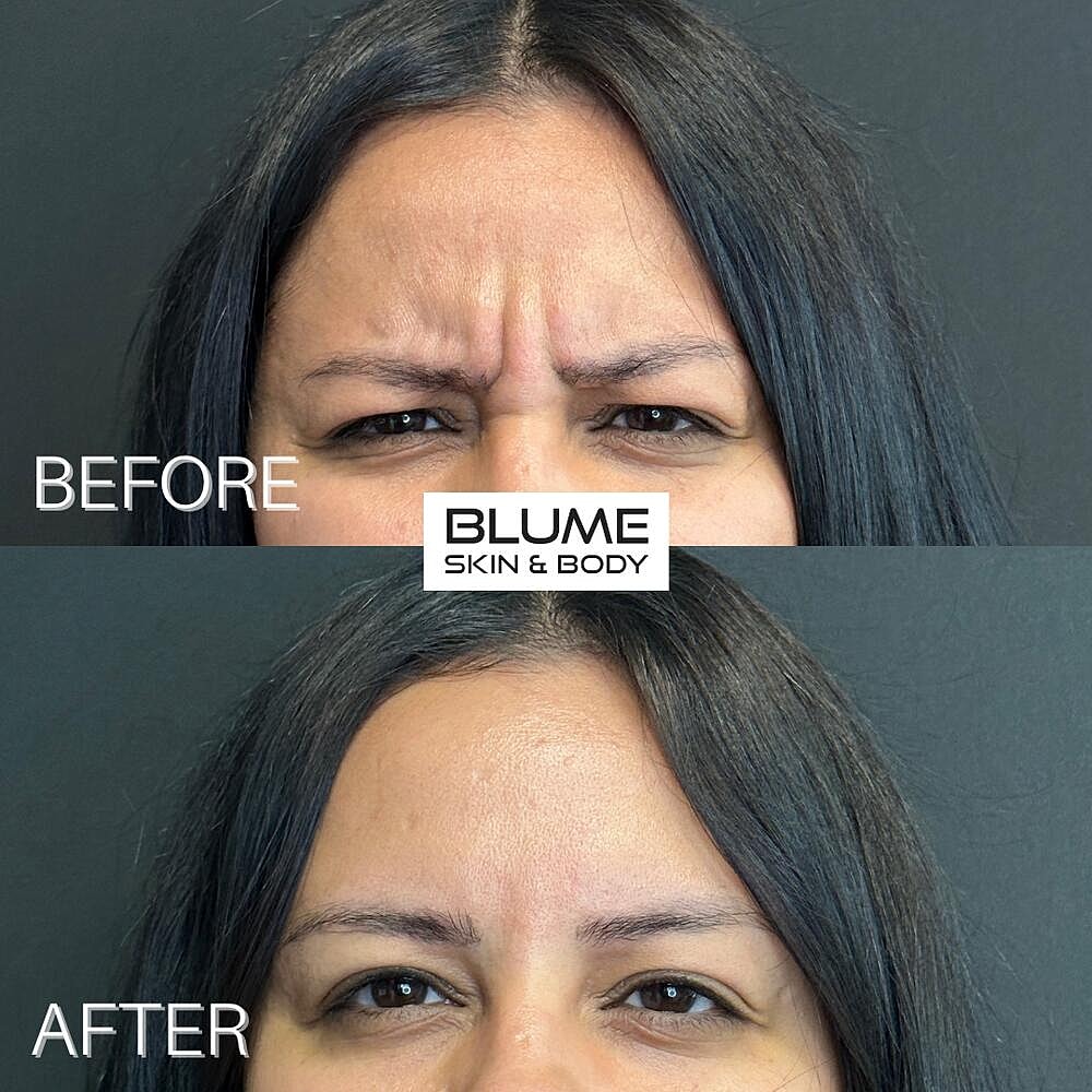 Botox Before & After