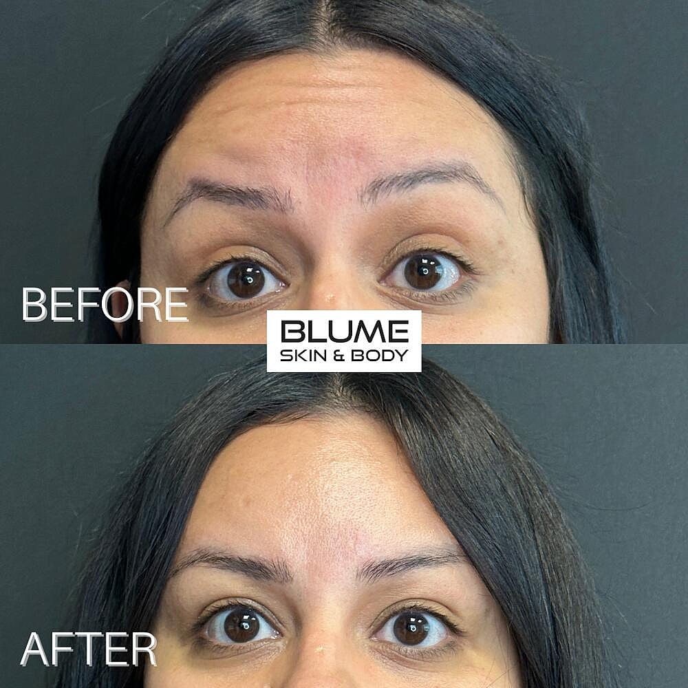 Botox Before & After