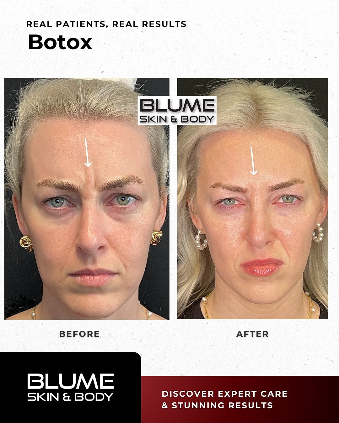 Botox Before & After
