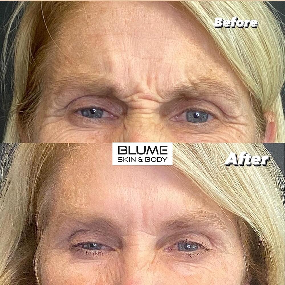 Botox Before & After