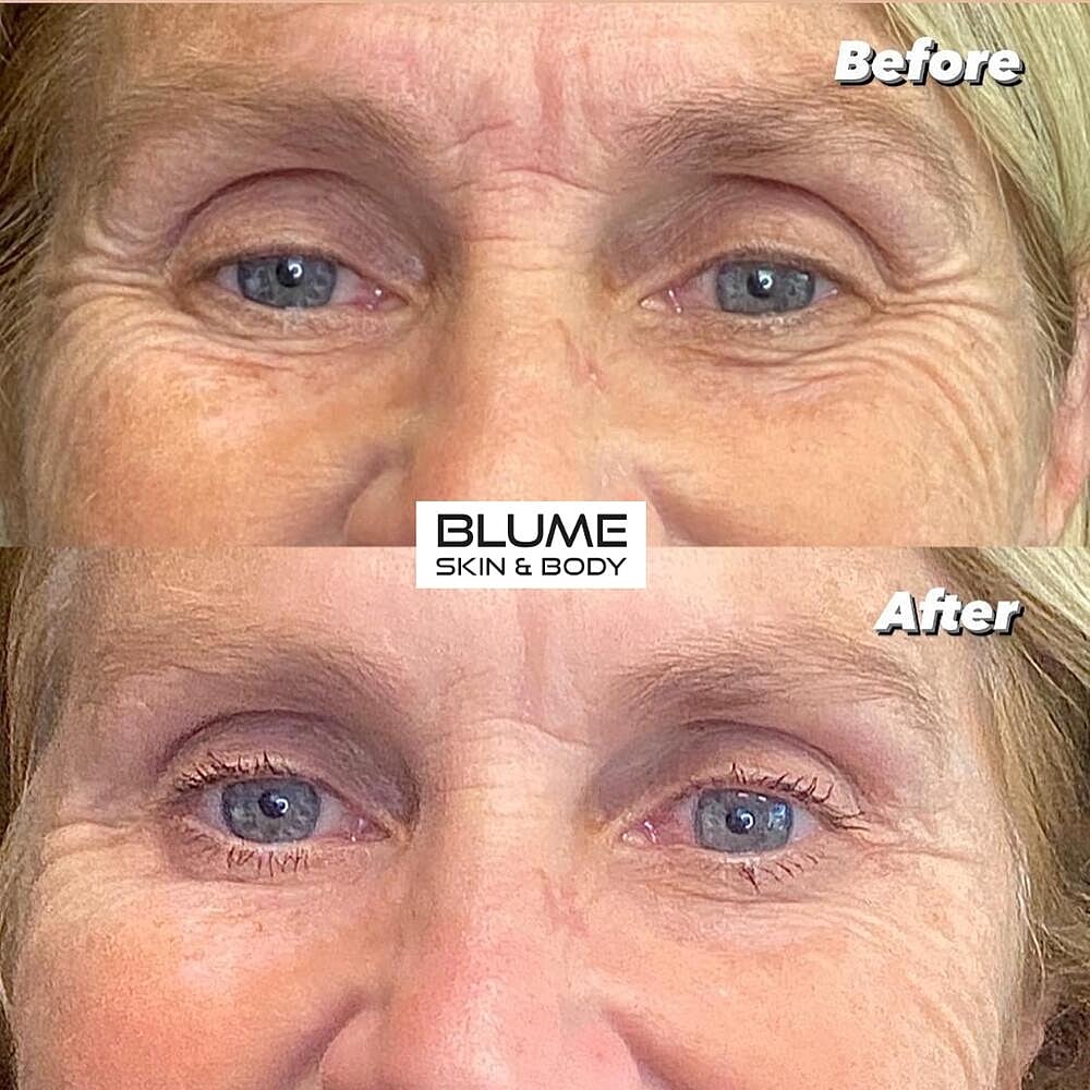 Botox Before & After