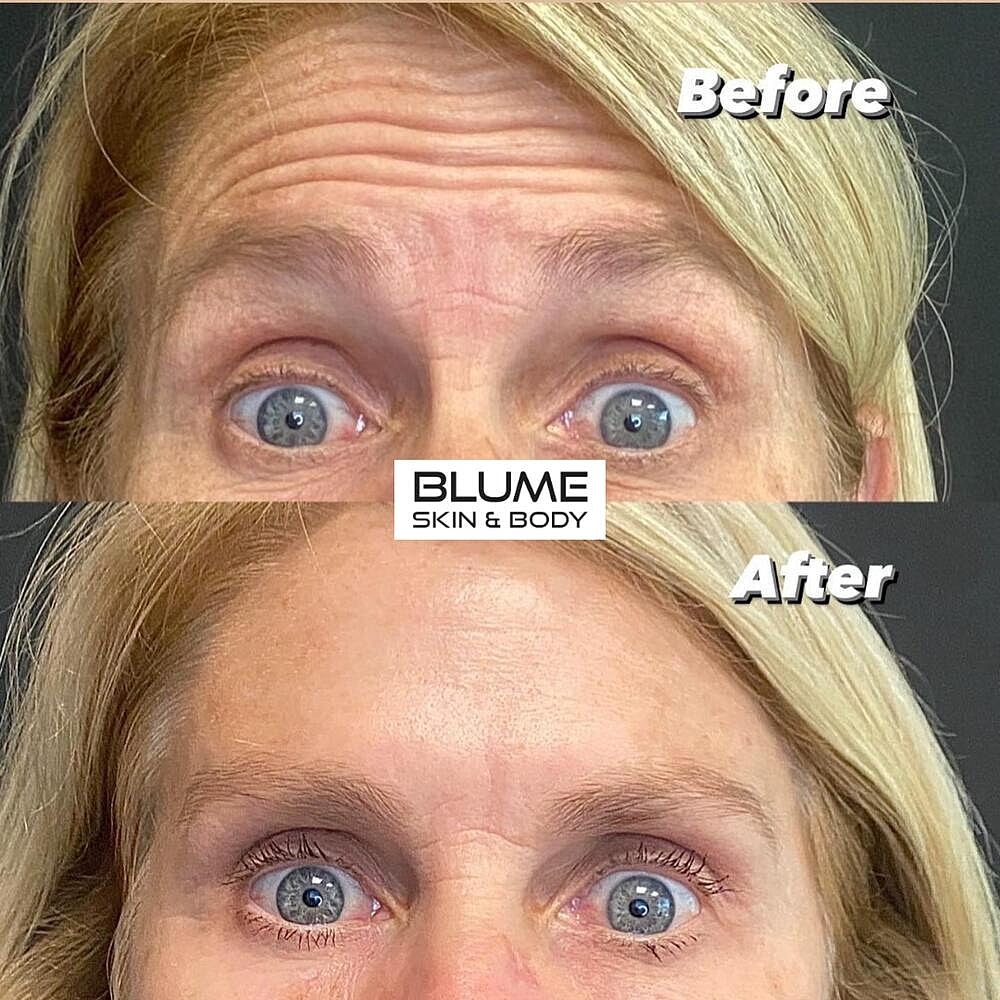 Botox Before & After