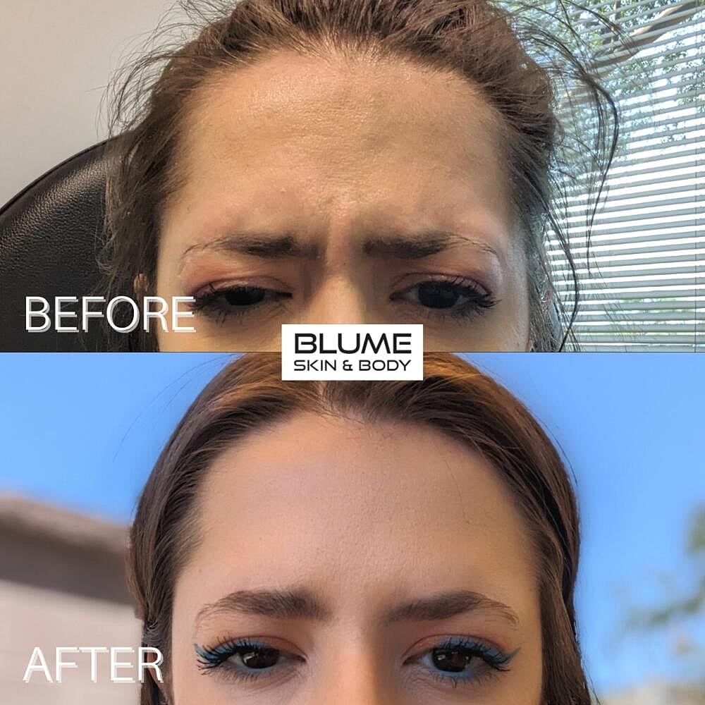 Botox Before & After