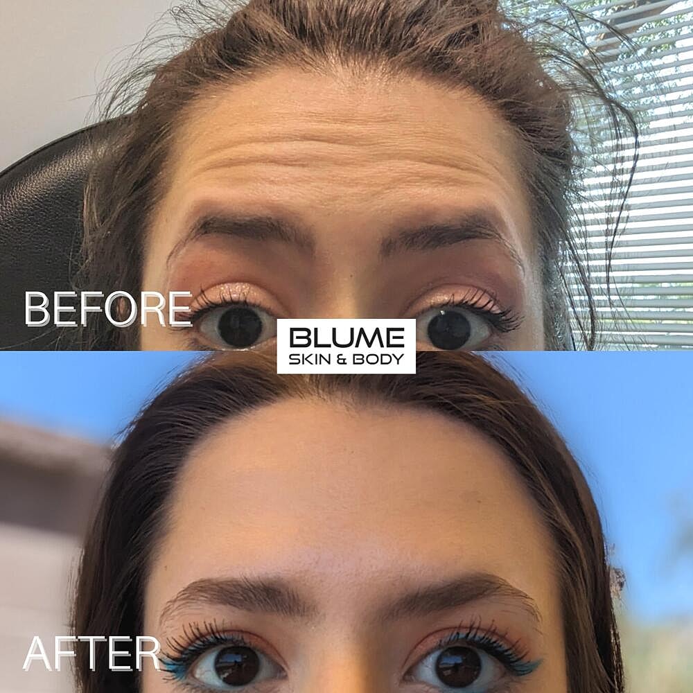 Botox Before & After