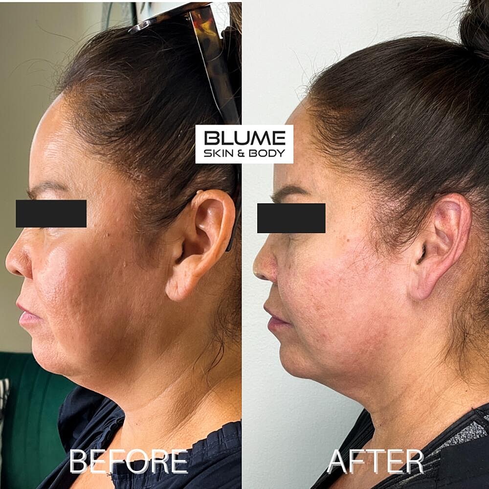 Botox Before & After