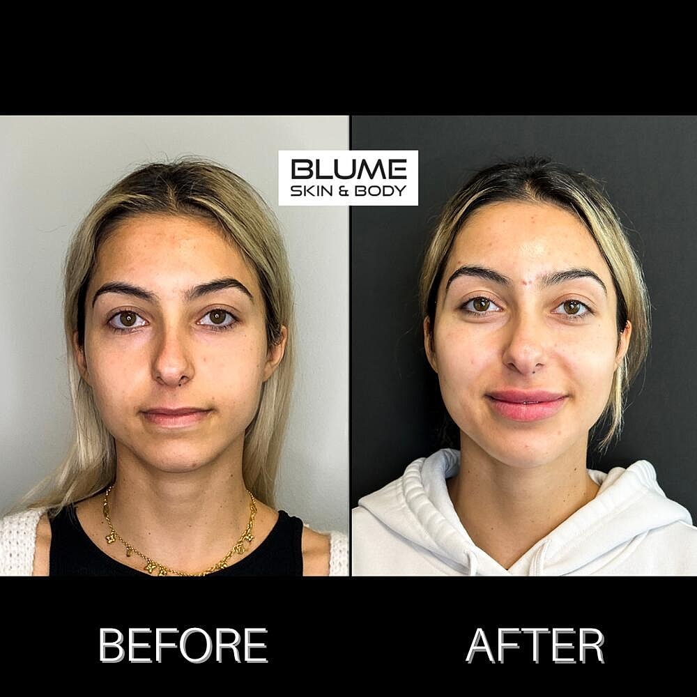 Botox Before & After