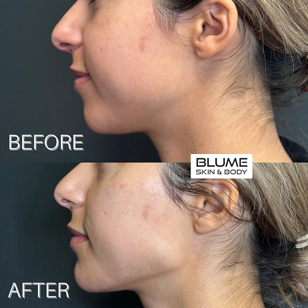 Botox Before & After