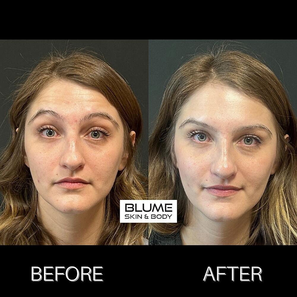 Botox Before & After