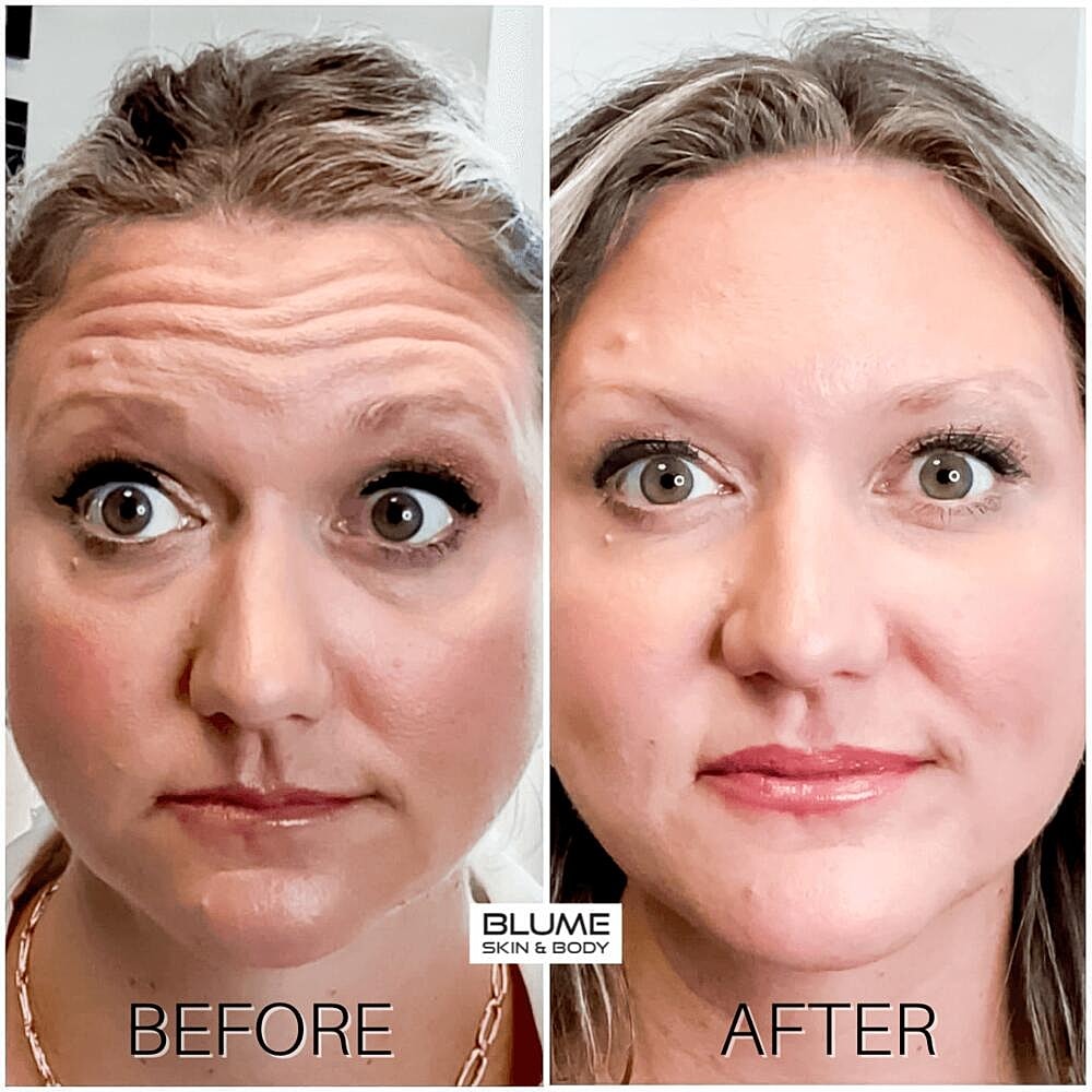 Botox Before & After