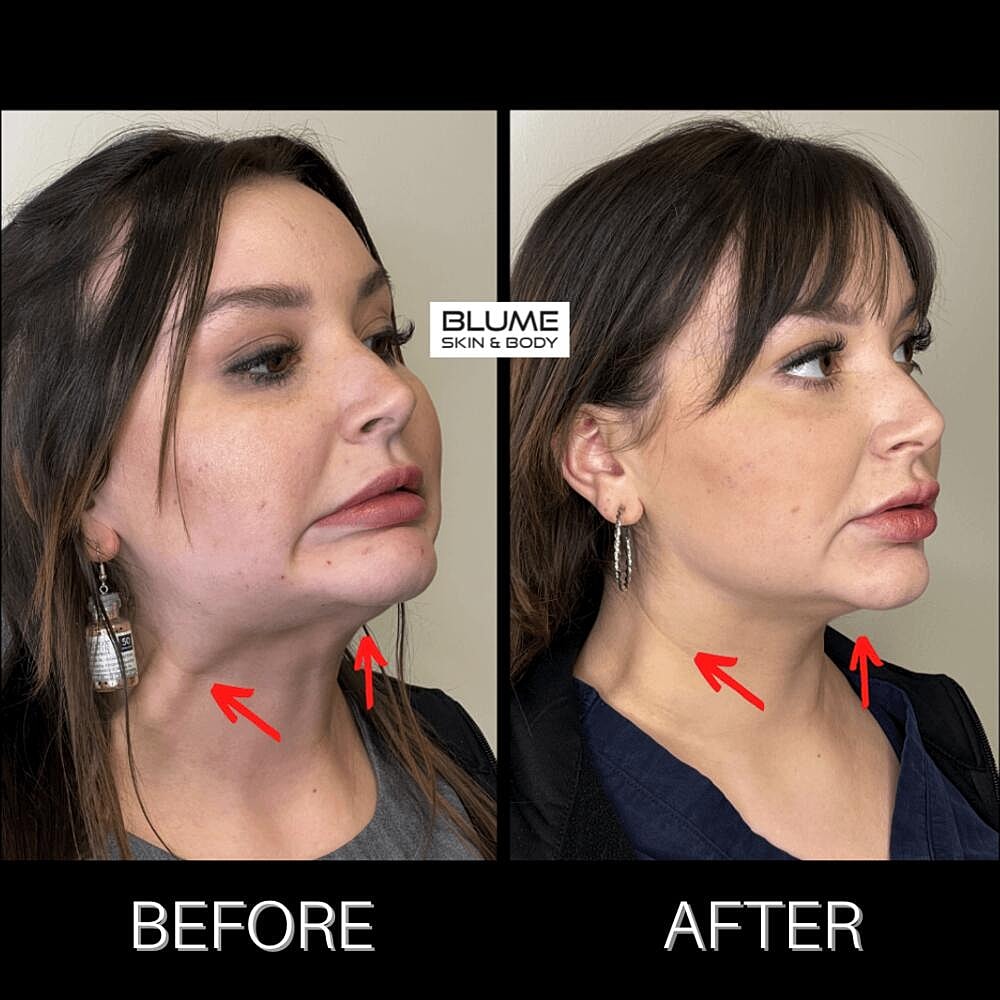 Botox Before & After