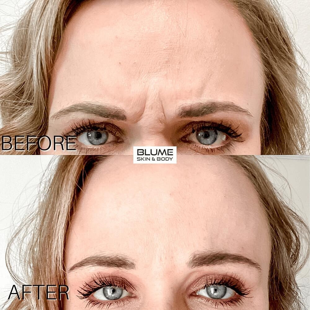 Botox Before & After