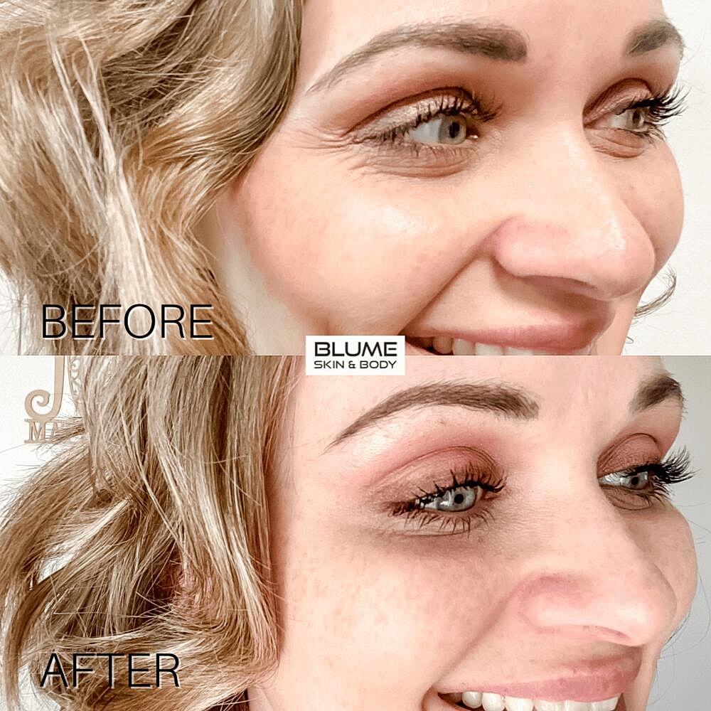 Botox Before & After