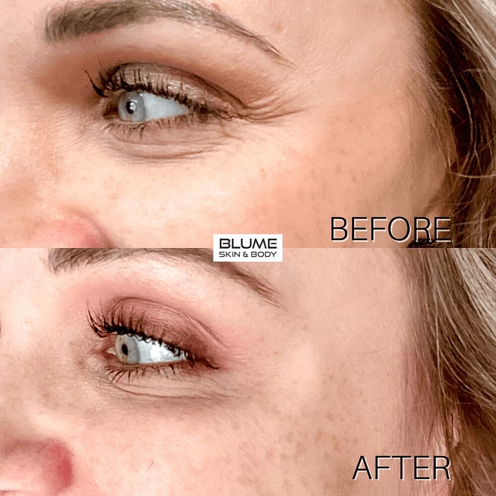 Botox Before & After