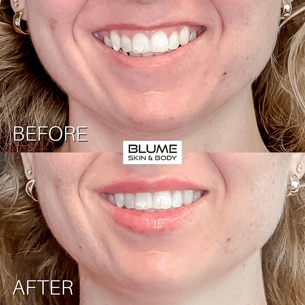 Botox Before & After