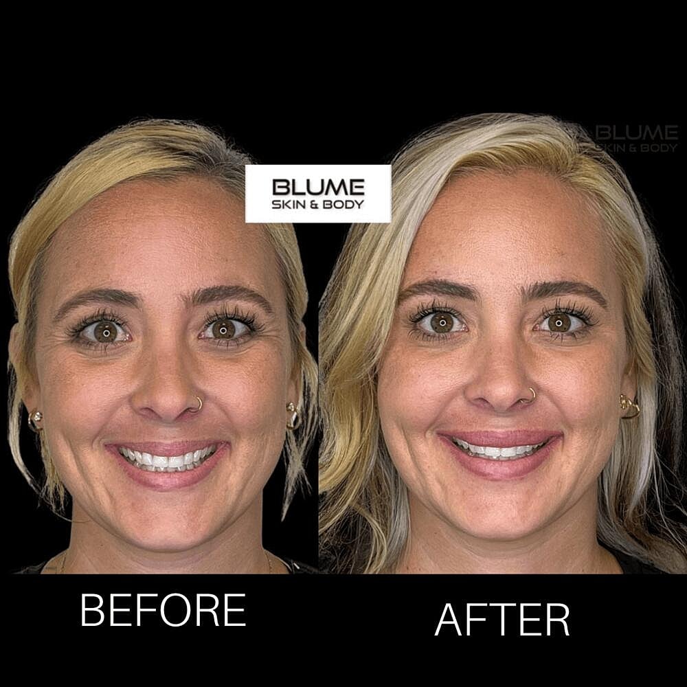 Botox Before & After