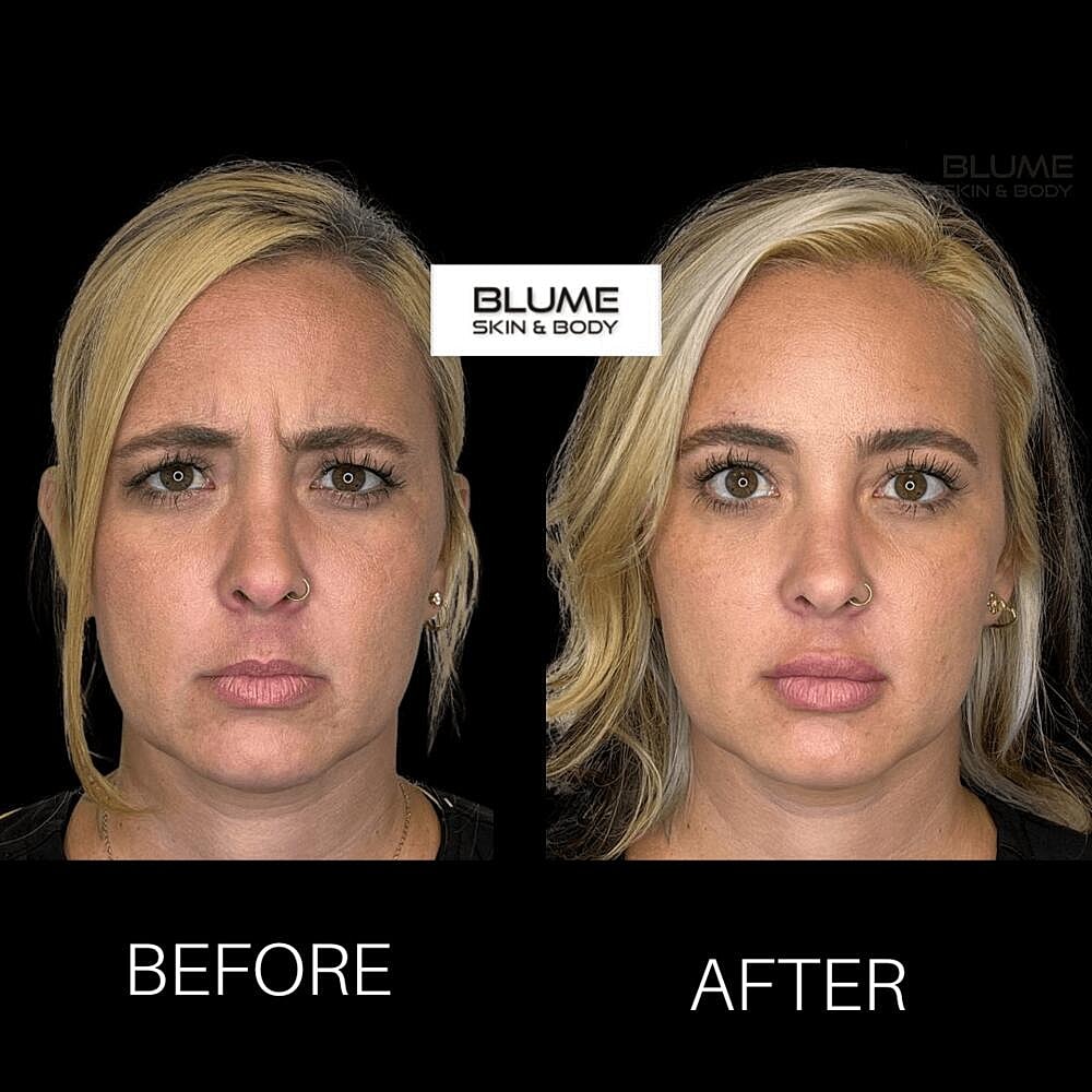 Botox Before & After