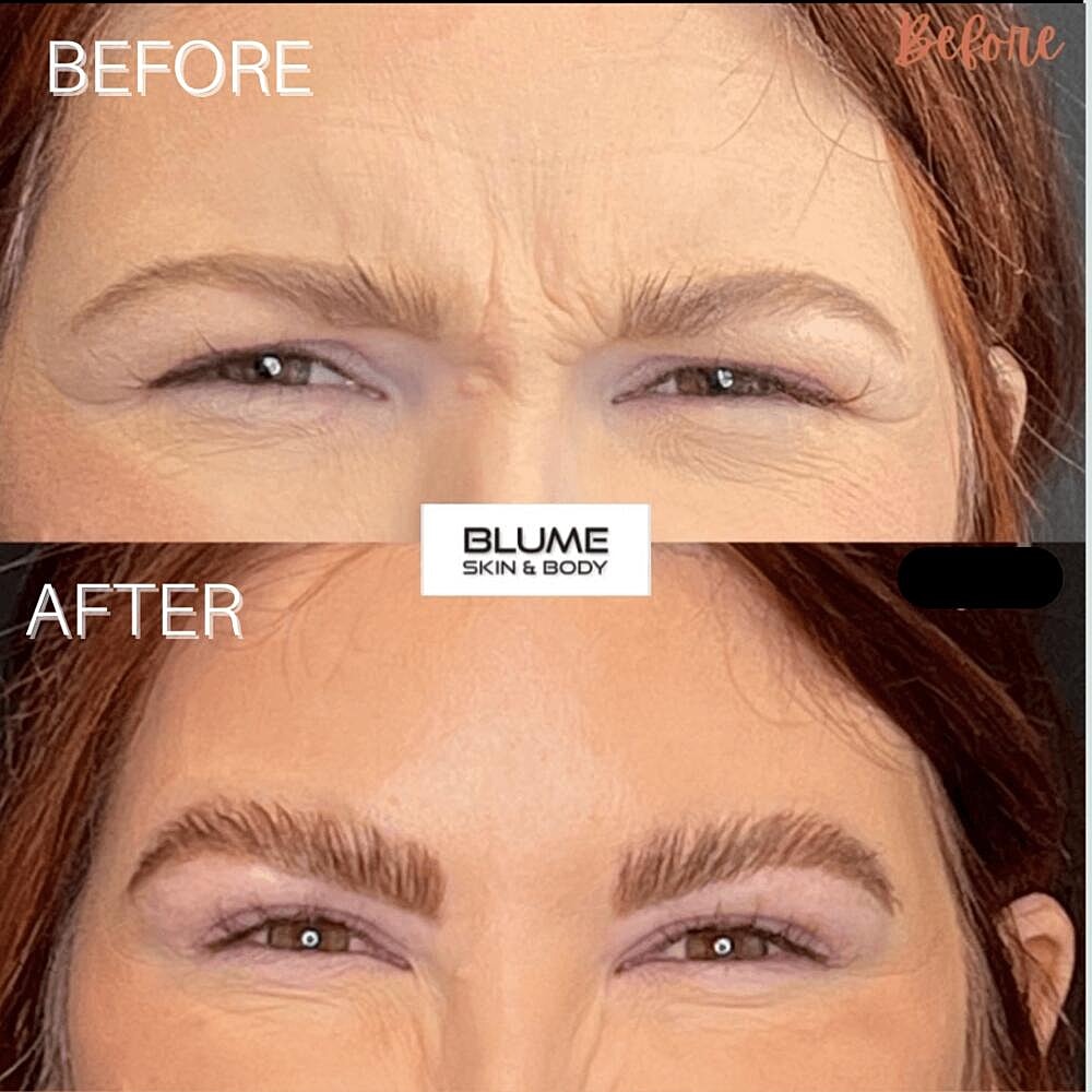 Botox Before & After